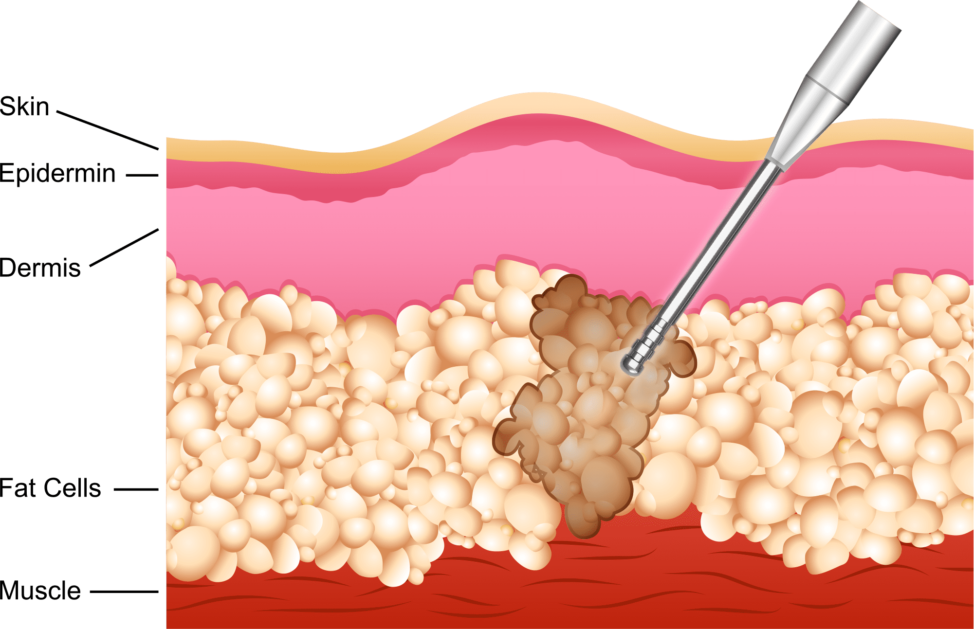 LSSA(エルサ)とは イメージ1