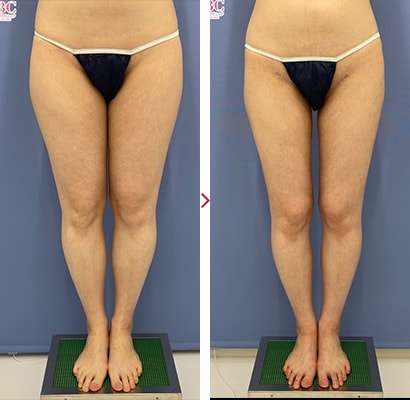 太ももの脂肪吸引｜脂肪吸引なら湘南美容クリニック【公式】