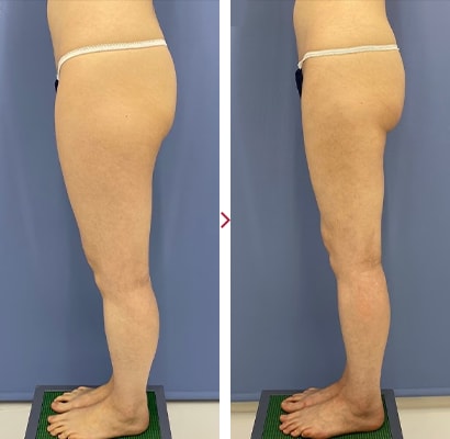 太ももAquicell（アキーセル）症例2