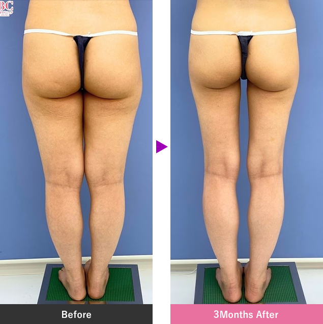 太ももの脂肪吸引ピックアップ症例ビフォーアフター