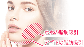 「ホホ」の脂肪吸引は「耳の裏」、「アゴ下」の脂肪吸引は「アゴの下」の目立たない箇所に傷ができますが、いずれも肌に同化しますので目立ちません。