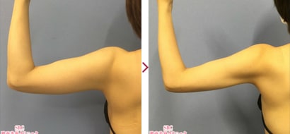 2枚セット　二の腕　脂肪吸引　ボレロ　Sサイズ　湘南美容外科　豊胸　ダウンタイム