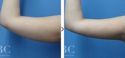 二の腕VASER(ベイザー)脂肪吸引症例2