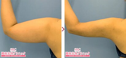 2枚セット　二の腕　脂肪吸引　ボレロ　Sサイズ　湘南美容外科　豊胸　ダウンタイム
