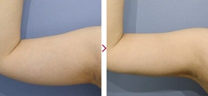 二の腕VASER(ベイザー)脂肪吸引症例3