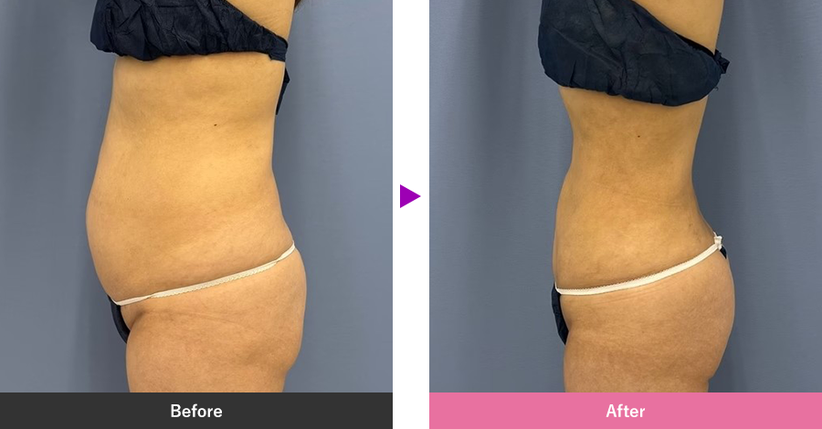 お腹の脂肪吸引の症例写真