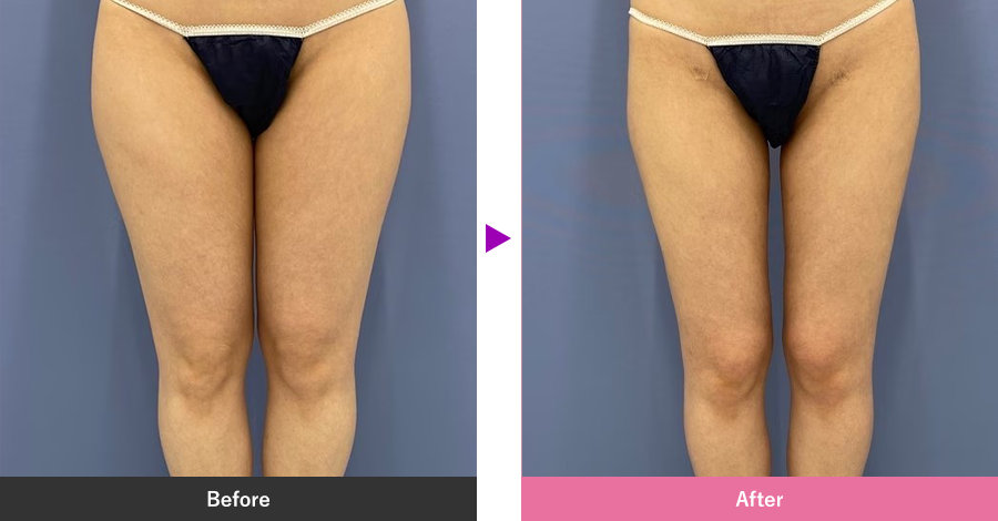 太ももの脂肪吸引の症例写真