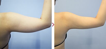 二の腕VASER(ベイザー)脂肪吸引症例4