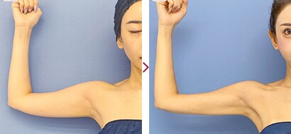 二の腕Aquicell（アキーセル）症例2