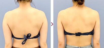 二の腕Aquicell（アキーセル）症例2