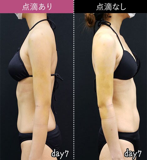 湘南美容外科　二の腕　圧迫　アミュレット　S 湘南美容外科 二の腕脂肪吸引 圧迫着 - メルカリ