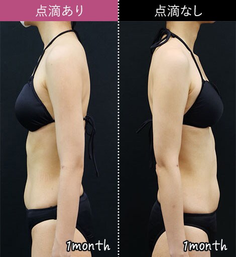 SBC 湘南美容外科 脂肪吸引 2枚セット 二の腕 着圧着 アミュレット アミュレット 二の腕 L ×2 着圧ボレロ 脂肪吸引 湘南美容