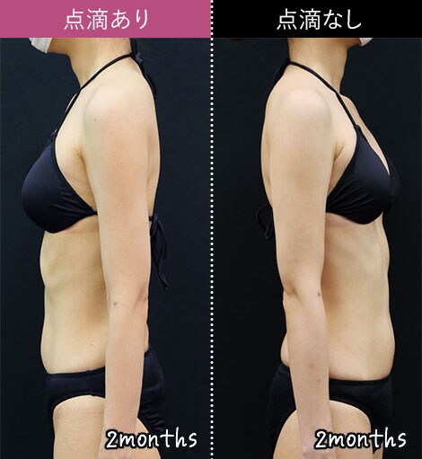 ダウンタイムの少ない脂肪吸引｜脂肪吸引なら湘南美容クリニック【公式】