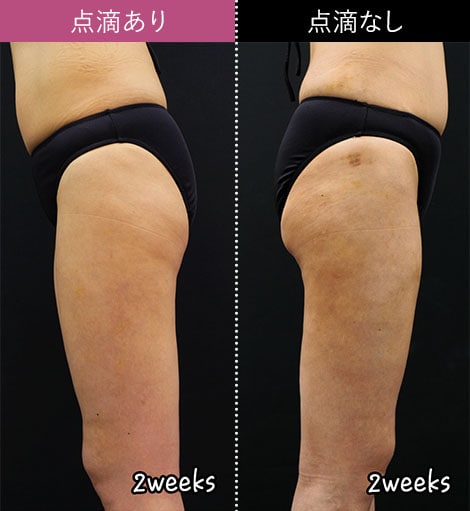 ダウンタイムの少ない脂肪吸引｜脂肪吸引なら湘南美容クリニック【公式】