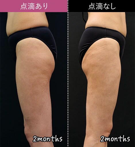 photo_drip_leg08.jpg?202672819553