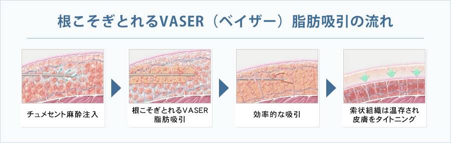 根こそぎとれるVASER（ベイザー）脂肪吸引の流れ