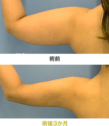 ピックアップ症例写真 二の腕01