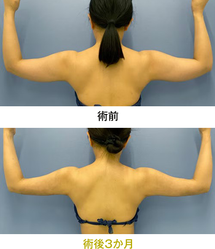 ピックアップ症例写真 二の腕02