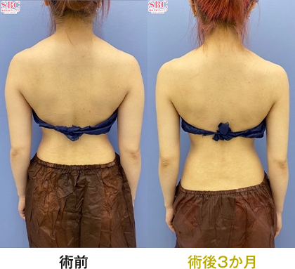 ピックアップ症例写真 二の腕03