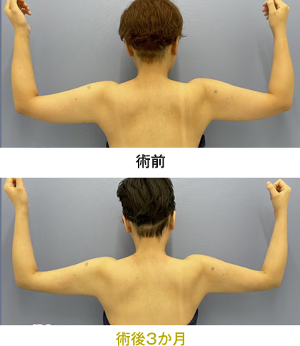 ピックアップ症例写真 二の腕04