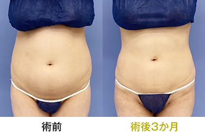 ピックアップ症例写真 お腹01