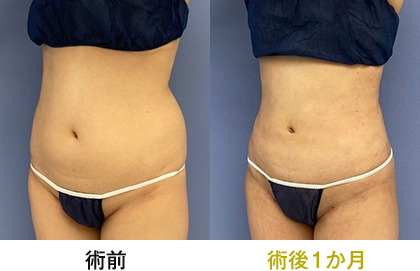 ピックアップ症例写真 お腹02