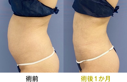 ピックアップ症例写真 お腹03