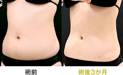 ピックアップ症例写真 お腹04