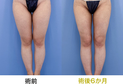 ピックアップ症例写真 太もも01