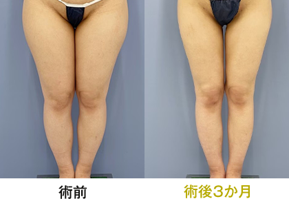 ピックアップ症例写真 太もも02