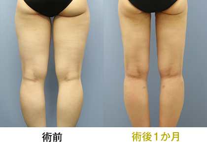 ピックアップ症例写真 太もも04