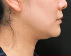 輪郭スッキリQ+~脂肪溶解リニアHIFU~ 症例写真 術前