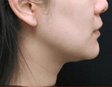 輪郭スッキリQ+~脂肪溶解リニアHIFU~ 症例写真 術後