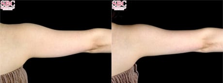 二の腕　メディカルサイズダウン　症例写真