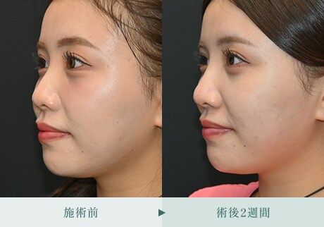 ヒアルロン酸症例 症例写真4