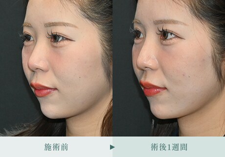 ヒアルロン酸症例 症例写真6