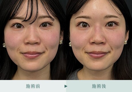 ヒアルロン酸症例 症例写真7