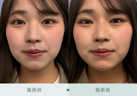 ヒアルロン酸症例 症例写真11