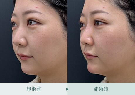 ヒアルロン酸症例 症例写真22