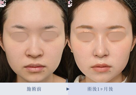 鼻整形症例 症例写真1