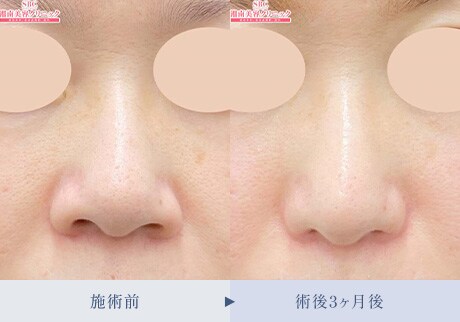 鼻整形症例 症例写真3