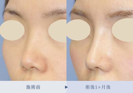 鼻整形症例 症例写真4