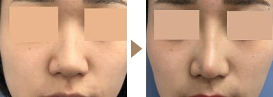 鼻尖形成+SBCプレミアムプロテーゼ+小鼻縮小　複合手術　症例写真　ビフォーアフター