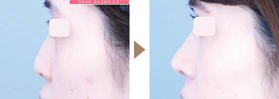 切らない小鼻縮小+鼻尖形成+(鼻への耳介軟骨移植)　複合手術　症例写真　ビフォーアフター