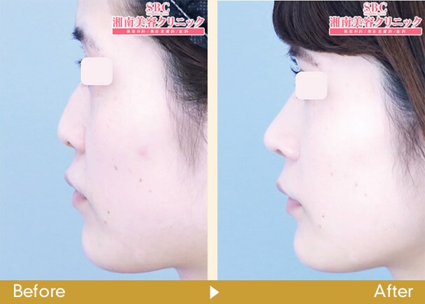 鼻尖部軟骨移植 鼻への耳軟骨移植 鼻整形なら湘南美容クリニック 公式