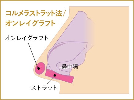 コルメラストラット法/オンレイグラフト