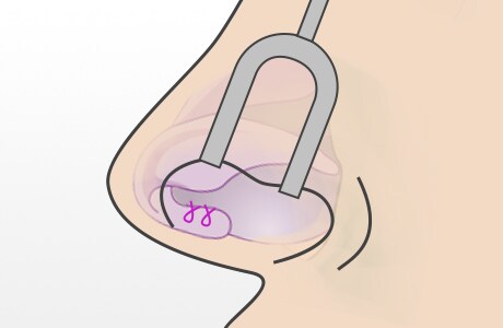 鼻柱拳上術の進め方2