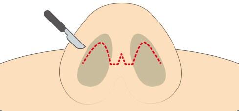 施術方法（鼻の穴の中を切開）