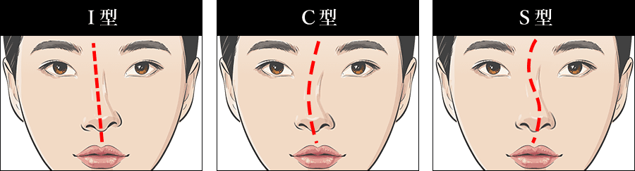 鼻の変形タイプ
