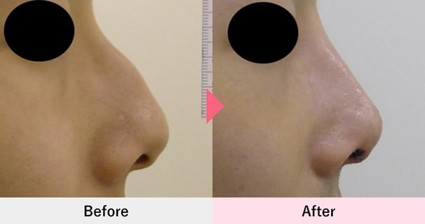 ワシ鼻修正術・ハンプ切除の症例写真4